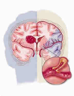 La apoplejia o isquemia cerebral y los tratamientos naturales La apoplejia o isquemia cerebral y los tratamientos naturales